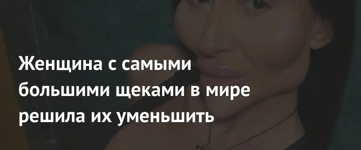 Украинская модель Анастасия Покрищук решила растворить филлеры в щеках ради подтяжки лица