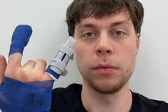 Популярный блогер Frame Tamer перенес экстренную операцию из-за серьезной травмы пальца